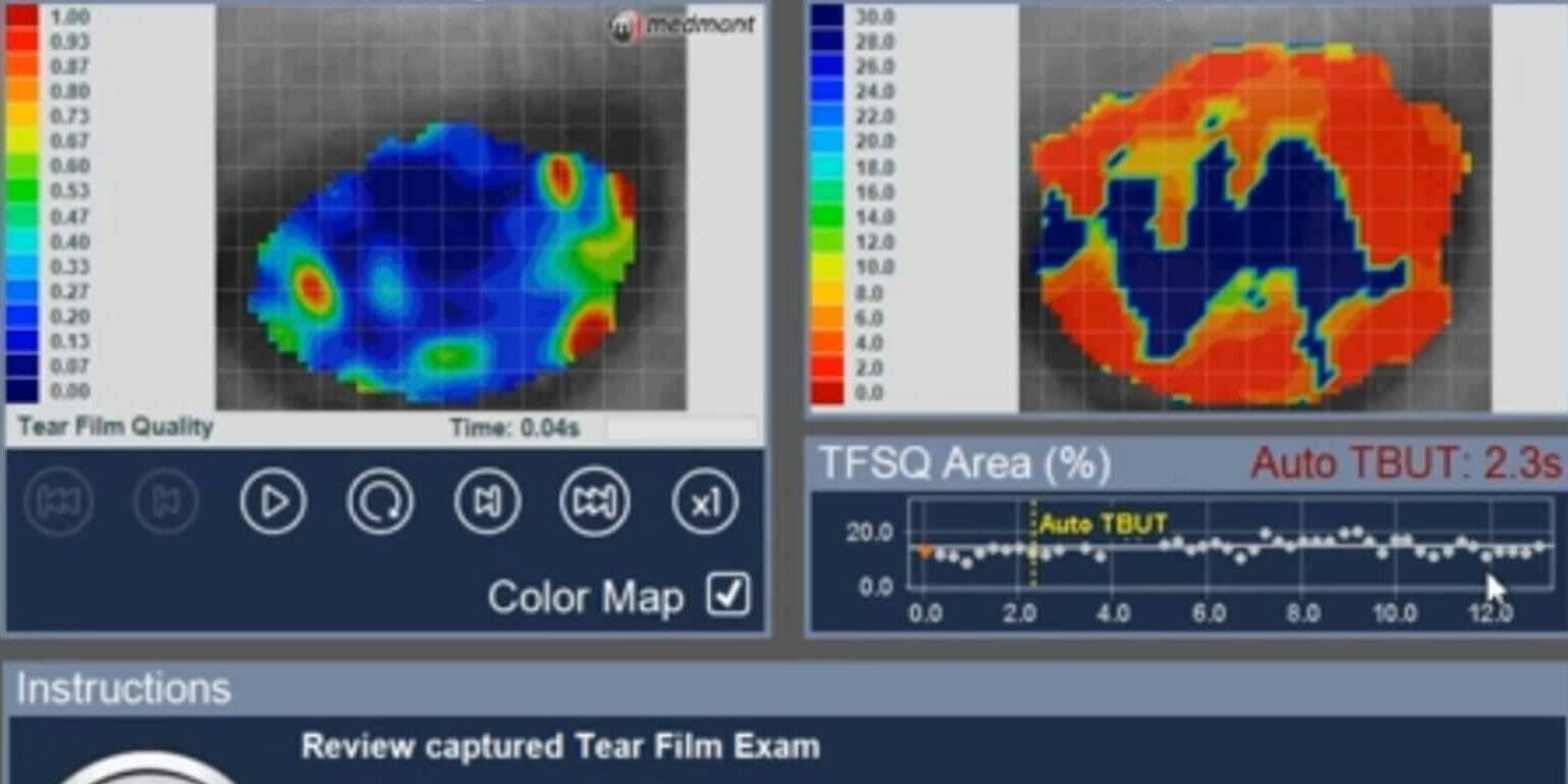 dry eye test