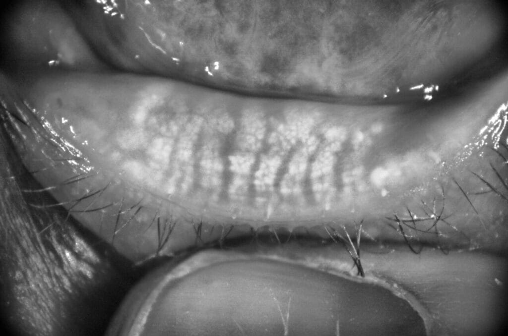 meibomian gland probing